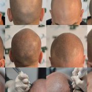 Micropigmentación de cuero cabelludo para hombres