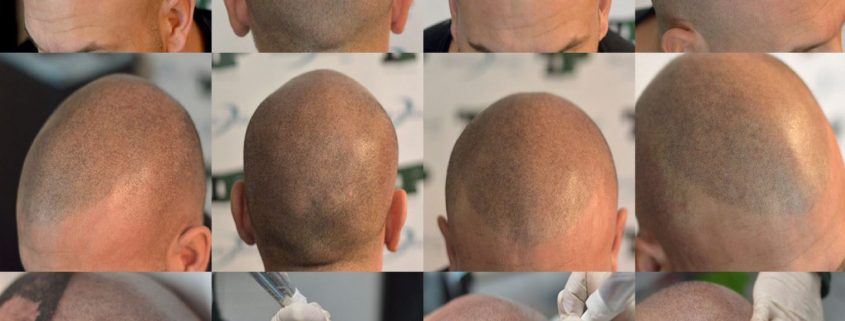 Micropigmentación de cuero cabelludo para hombres