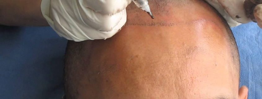 Trabajo de pigmentación de cuero cabelludo para hombres en Bogotá Microblading con colores naturales